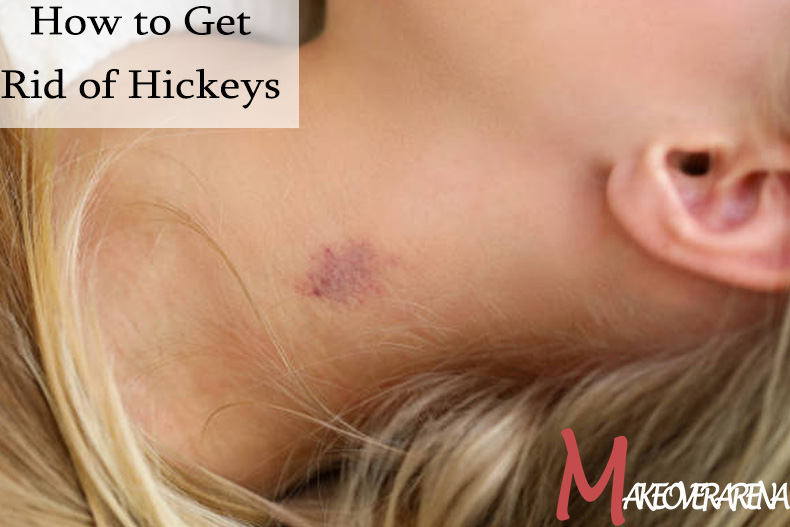 How to Get Rid of Hickeys 
